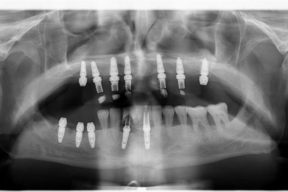 Implaturi si sinus lift - Poza 003