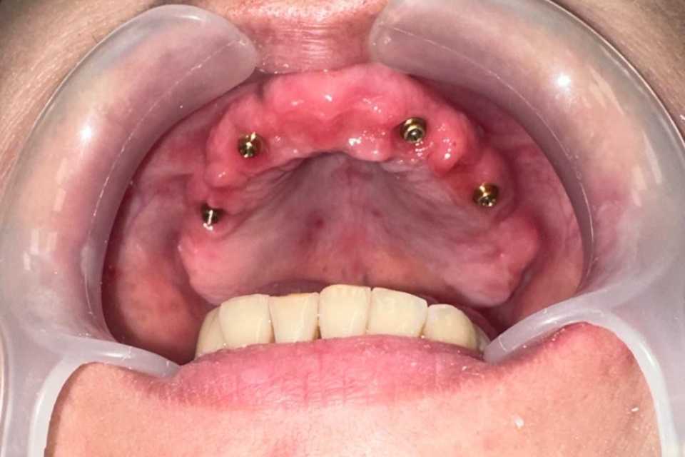 Reabilitare implaturi Mega Gen Anyridge - Poza 009