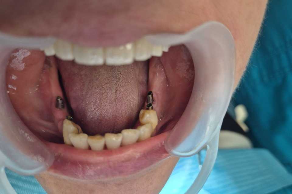 Reabilitare implaturi Mega Gen Anyridge - Poza 001