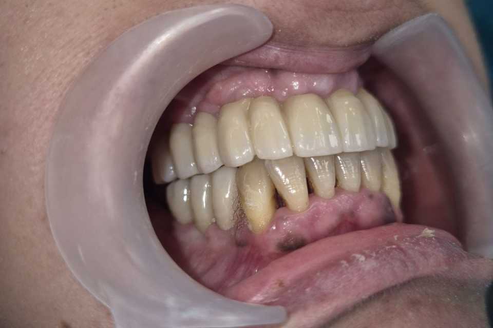 Reabilitare implaturi Mega Gen Anyridge - Poza 002