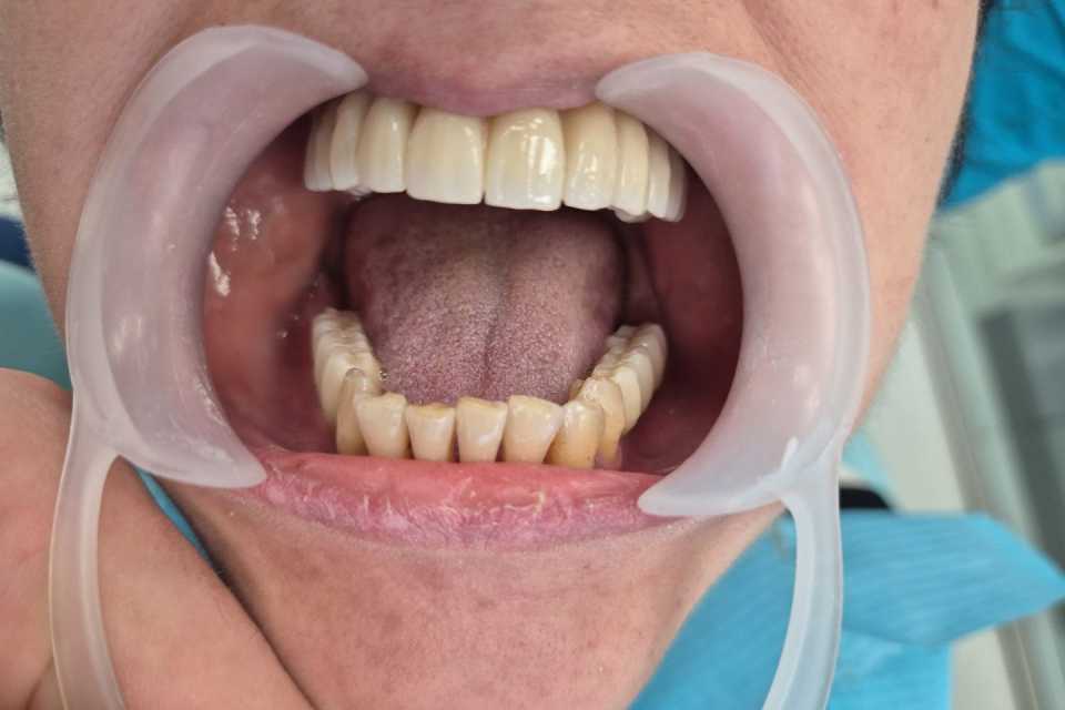 Reabilitare implaturi Mega Gen Anyridge - Poza 004