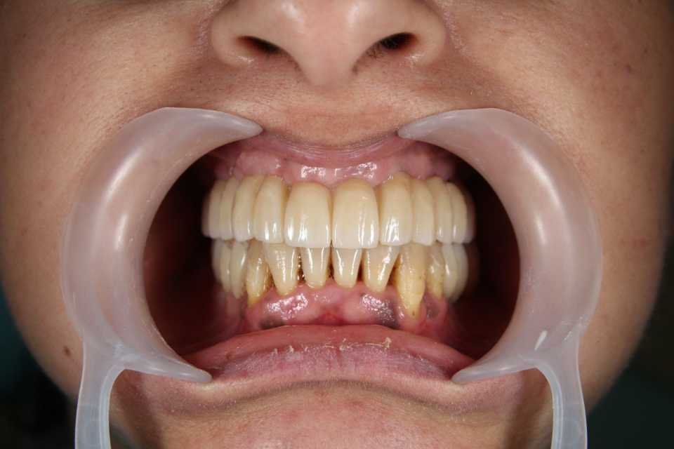 Reabilitare implaturi Mega Gen Anyridge - Poza 005