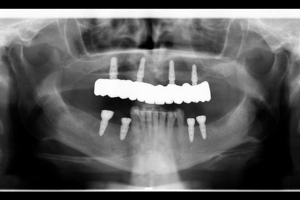 Reabilitare implaturi Mega Gen Anyridge - Poza 010