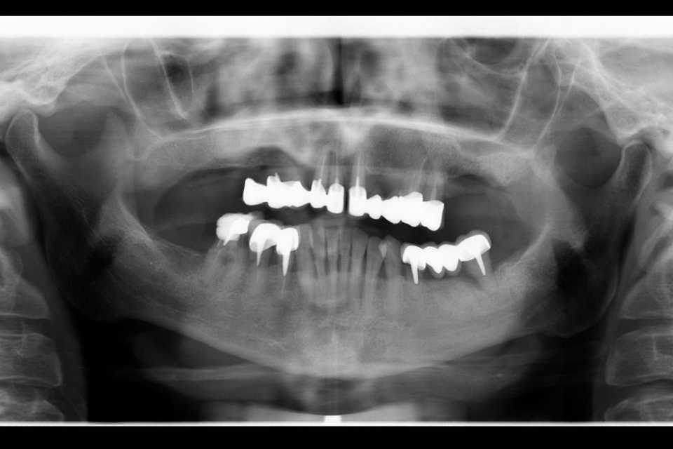 Reabilitare implaturi Mega Gen Anyridge - Poza 011