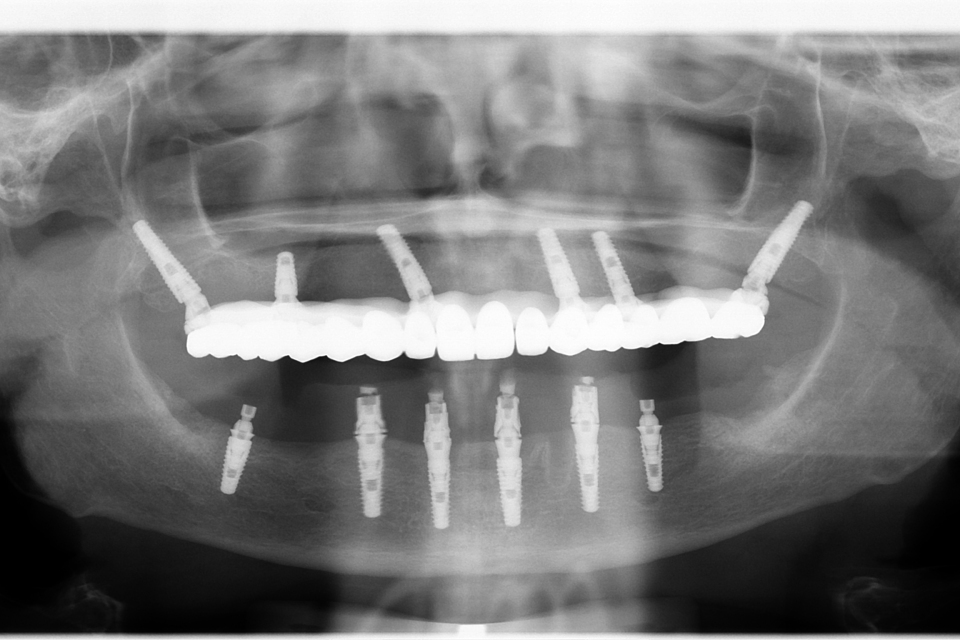 All on 6, protezate cu lucrare din zirconiu pe suport de titan