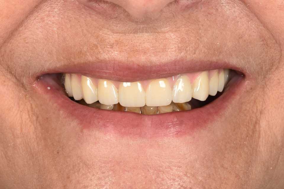 All on 6 cu implanturi orale speciale pterigoide, lucrare protezată din zirconiu pe suport de titan înșurubabilă