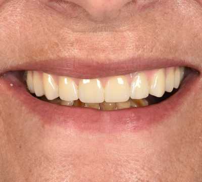 All on 6 cu implanturi orale speciale pterigoide, lucrare protezată din zirconiu pe suport de titan înșurubabilă