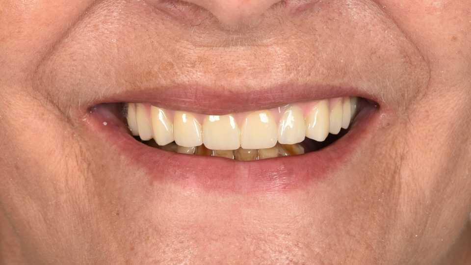 All on 6 cu implanturi orale speciale pterigoide, lucrare protezată din zirconiu pe suport de titan înșurubabilă